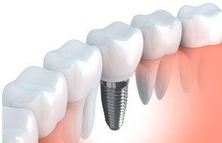 Dental Implants - Worth The Investment!