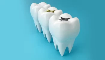 What to Expect During a Dental Filling Procedure